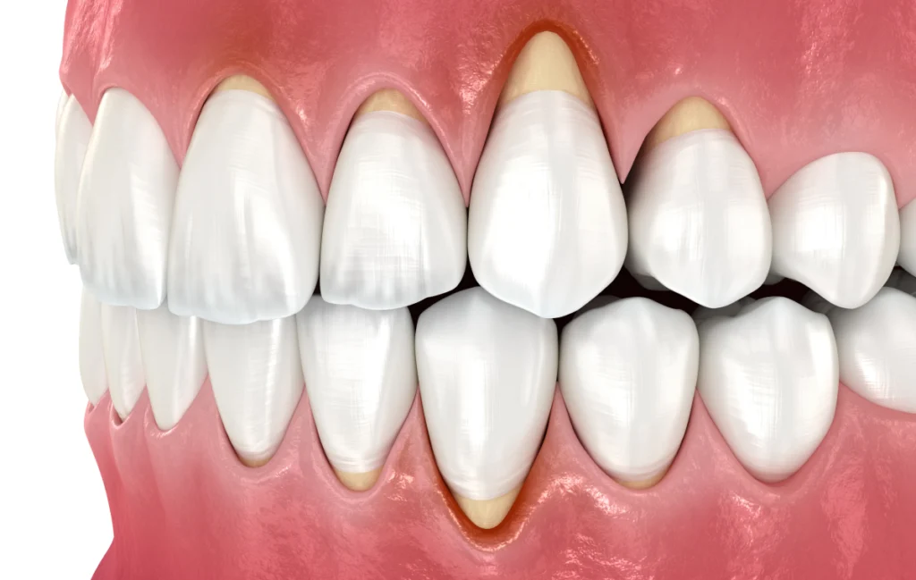 Soins chirurgicaux des gencives